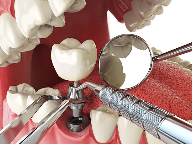 Best Urgent Tooth Repair  in Burnt Mills, MD